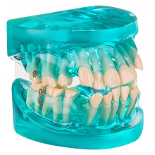 Демонстрационная модель Revyline "Зубы" с ортодонтическими имплантами в Екатеринбурге